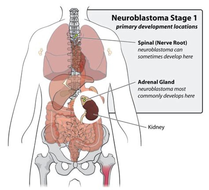 Are all neuroblastomas cancerous?