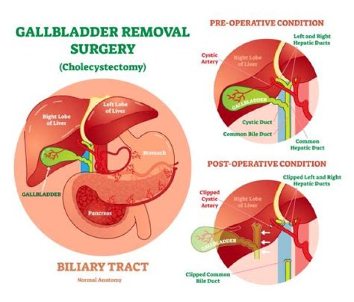 Are gallbladder surgery dangerous?