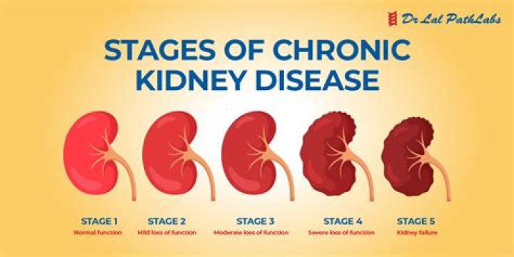 Are kidney stones chronic?