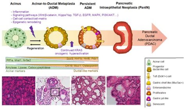 Are metaplasia and dysplasia the same?