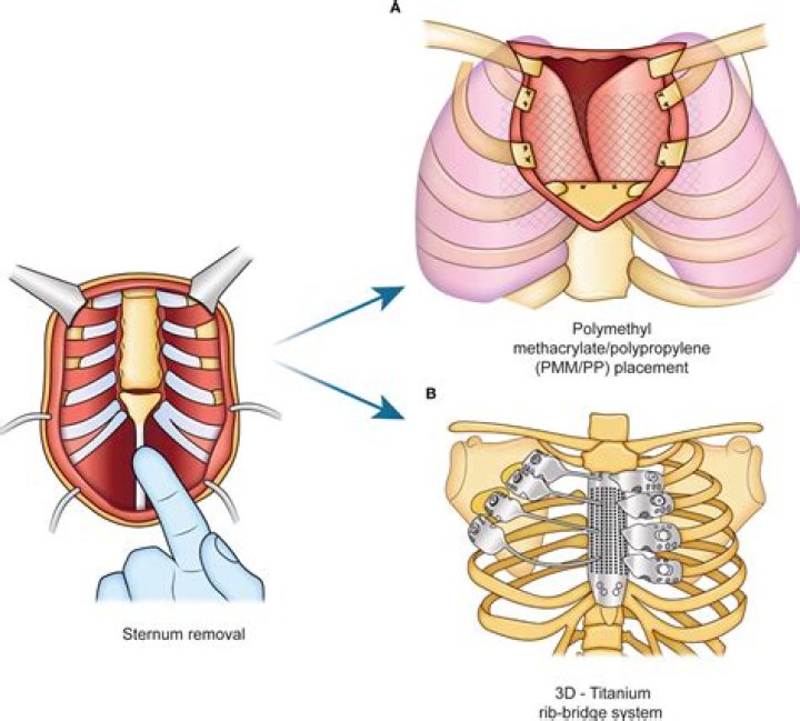 Are sternal wires magnetic?
