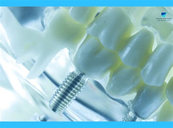 Are titanium implants safe?