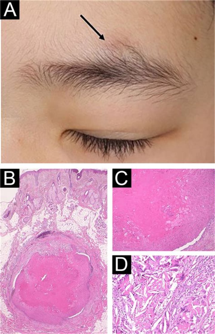 Are trichilemmal cyst dangerous?