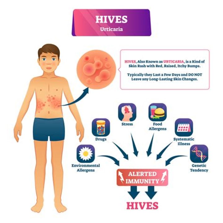 Are viral hives contagious?