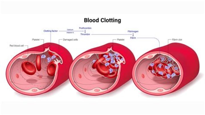 At risk for blood clots?