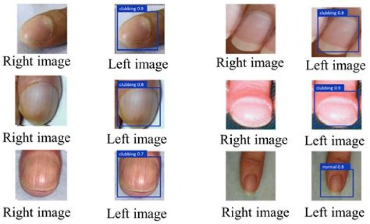 Can a myxoma return?