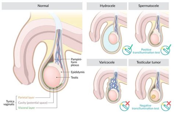 Can a testicle dissolve?