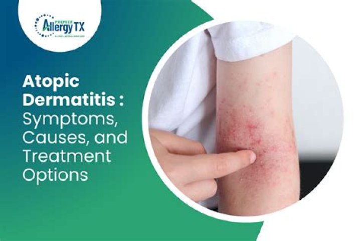 Can antihistamines help atopic dermatitis?