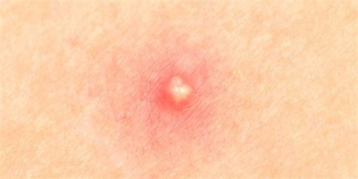 Can blackheads get infected?