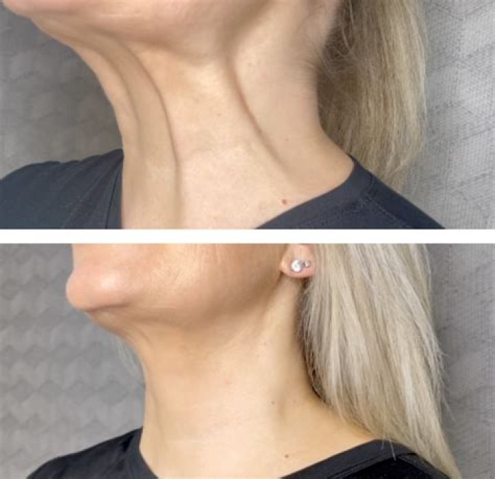 Can botox help neck bands?