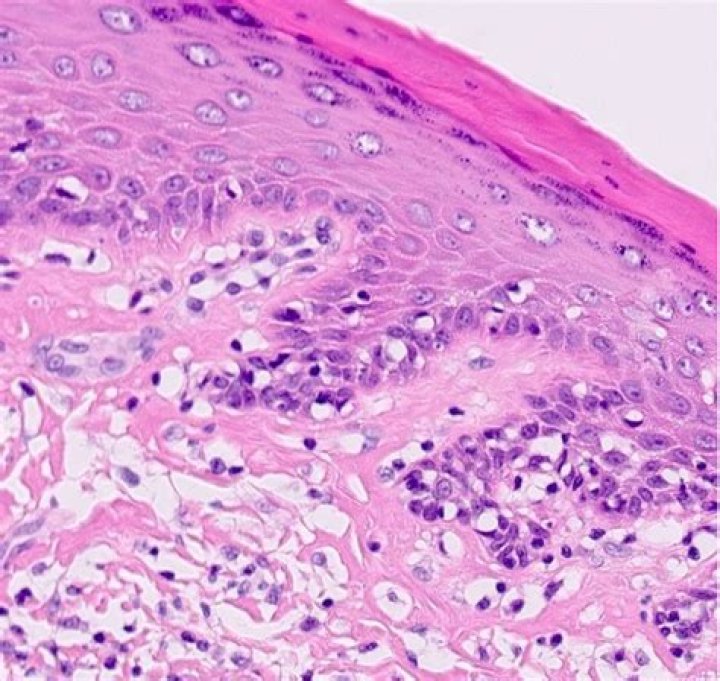 Can lichen sclerosus be misdiagnosed?