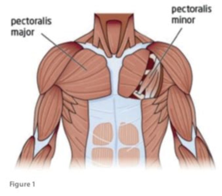 Can pectoral muscle cause numbness?
