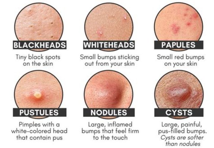 Can pimples be rock hard?