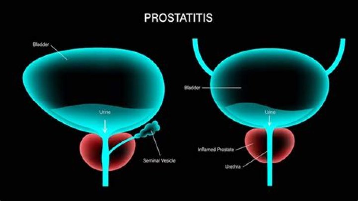 Can prostatitis affect bowel movements?