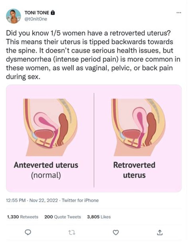 Can retroverted uterus cause constipation?