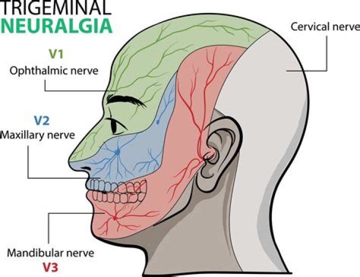 Can trigeminal neuralgia cause tooth pain?
