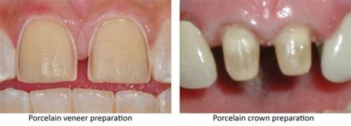 Can veneers fall off?