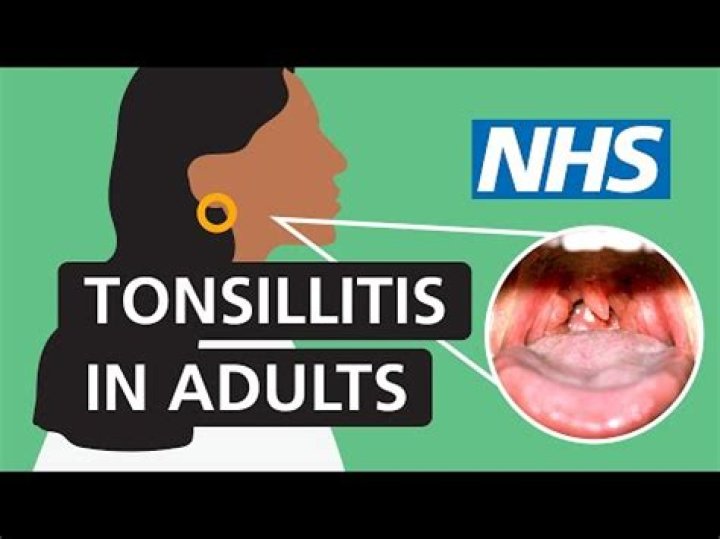 Can you get exudate with viral tonsillitis?