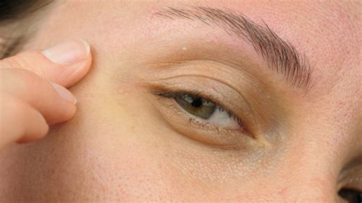 Can you pop a white bump on eyelid?