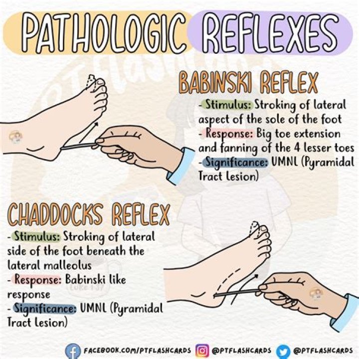 Do babies have clonus?