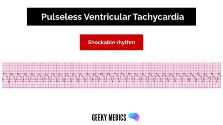 Do you sync pulseless v tach?