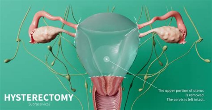Does a hysterectomy remove the uterus?