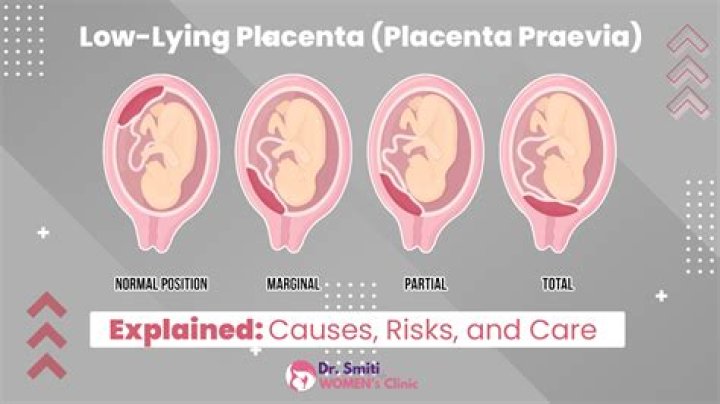 Does a low lying placenta move up?