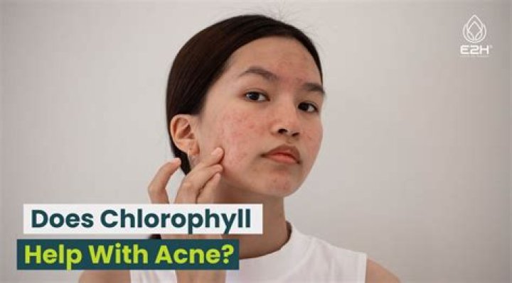 Does chlorophyll help with acne?