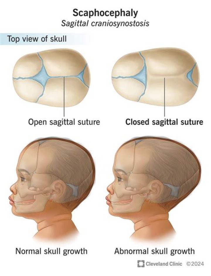 Does dolichocephaly correct itself?