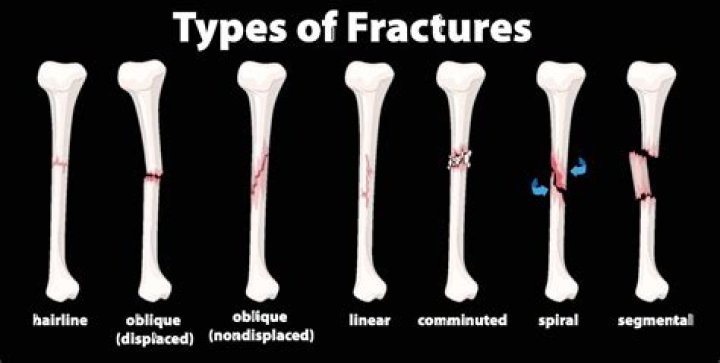 Does fractured mean broken?