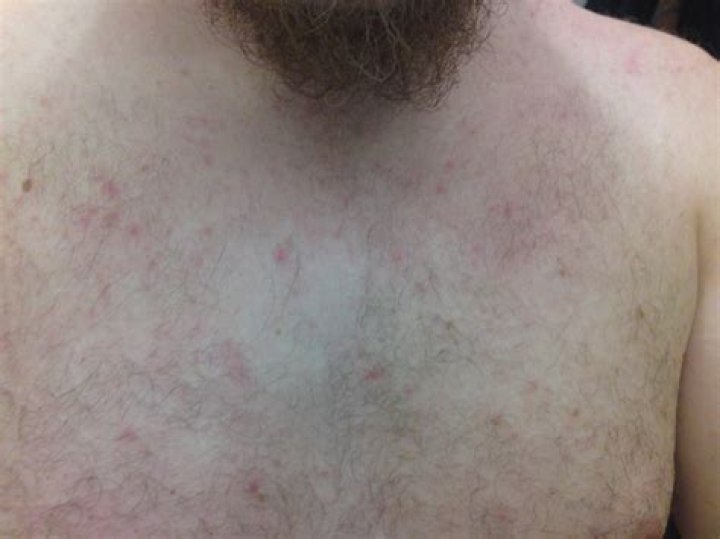 Does miliaria rubra spread?