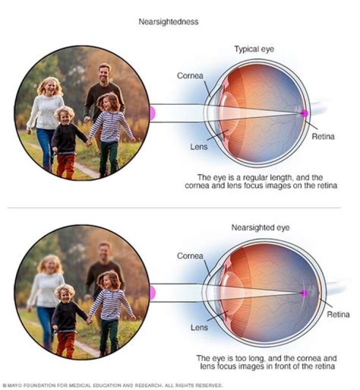 Does nearsightedness cause blindness?