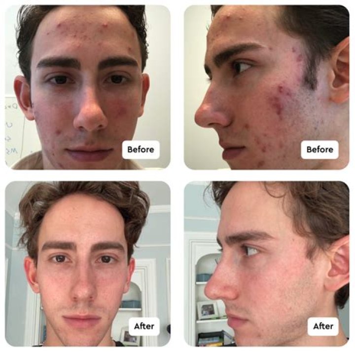 Does oily skin return after accutane?