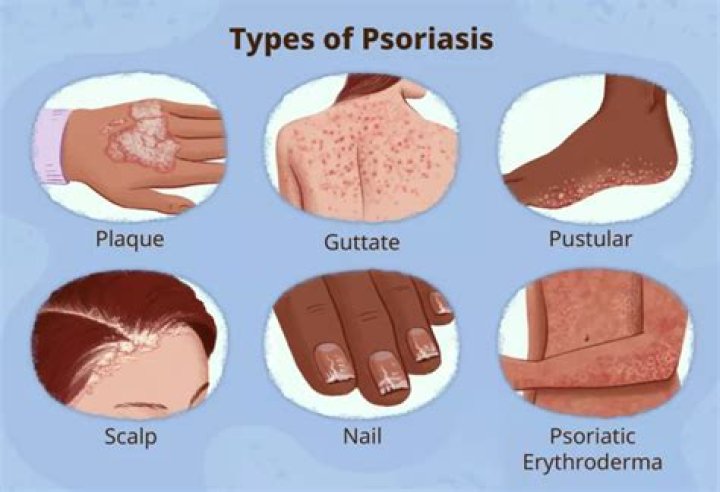 Does psoriasis get itchy?