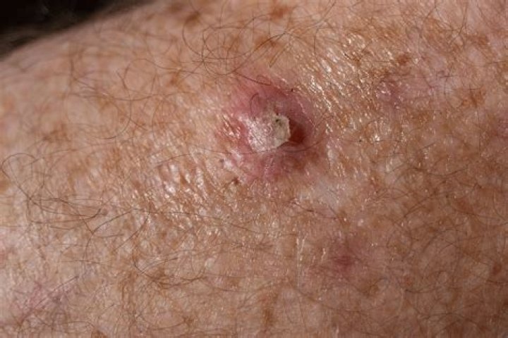 Does squamous mean cancer?