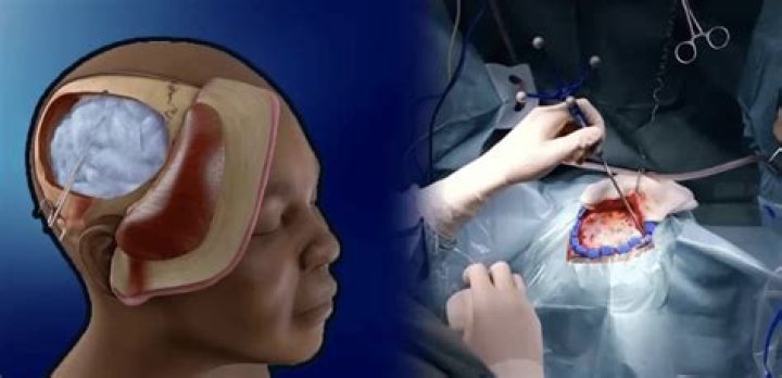 During a craniotomy the brain is protected with?