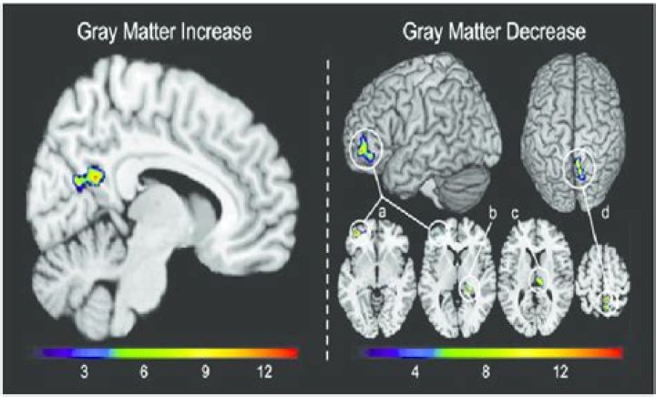 During adolescence gray matter decreases due to?