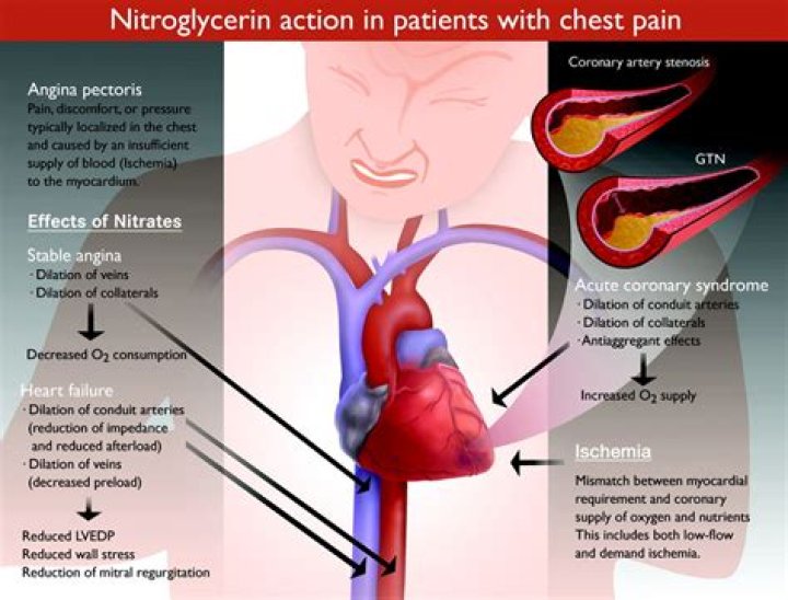 During angina attack nitroglycerin is given by?