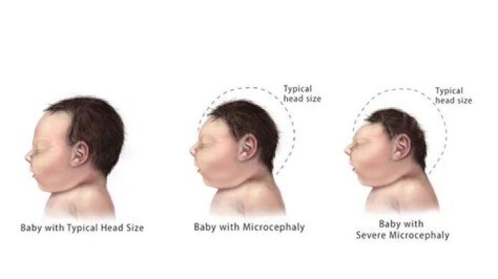 Has my baby got microcephaly?