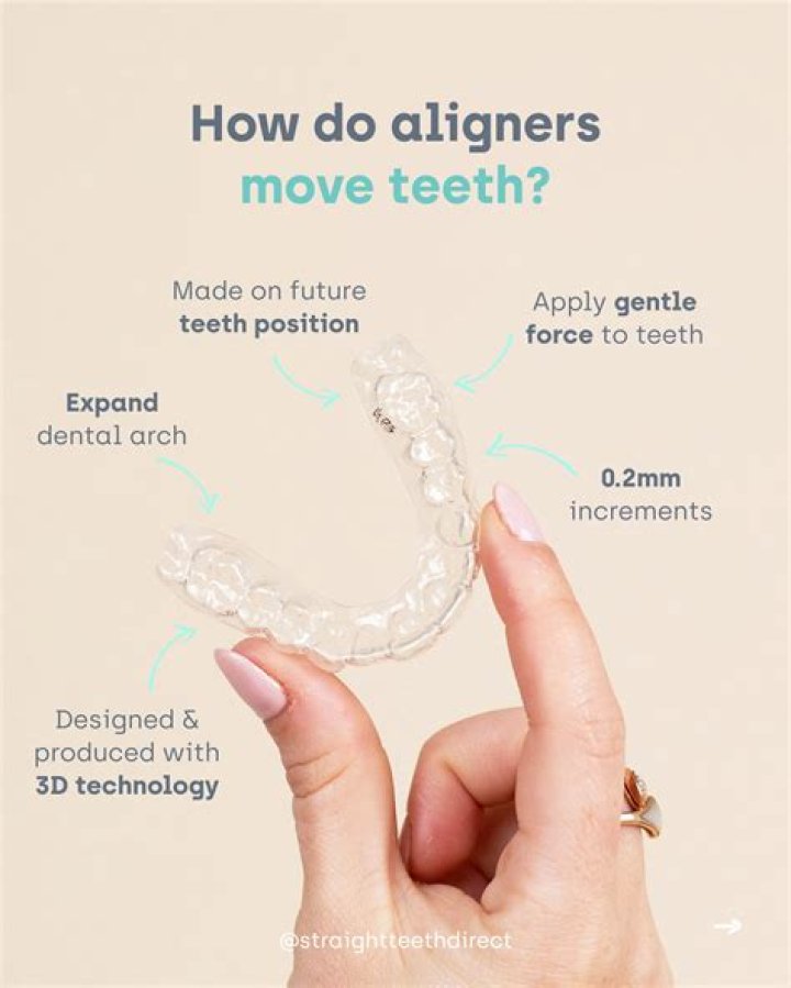 How aligners should fit?