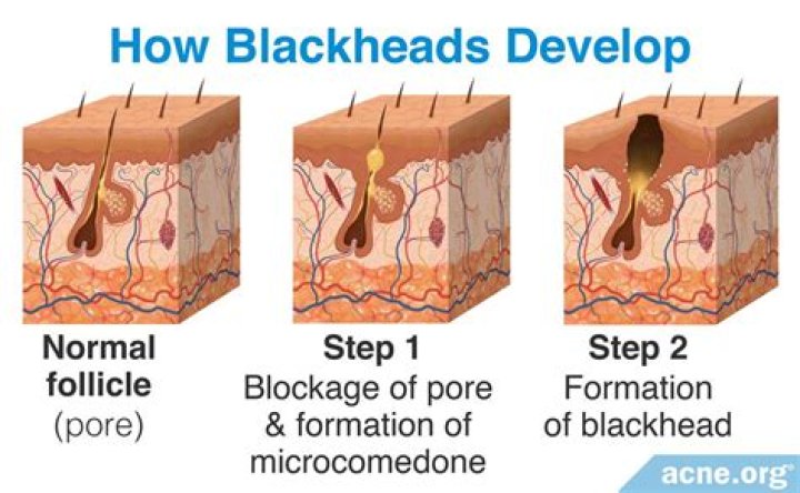 How blackheads are removed?