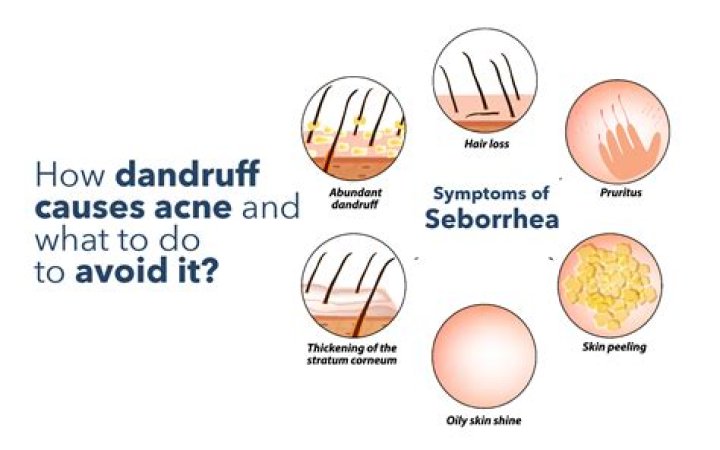 How dandruff causes acne?