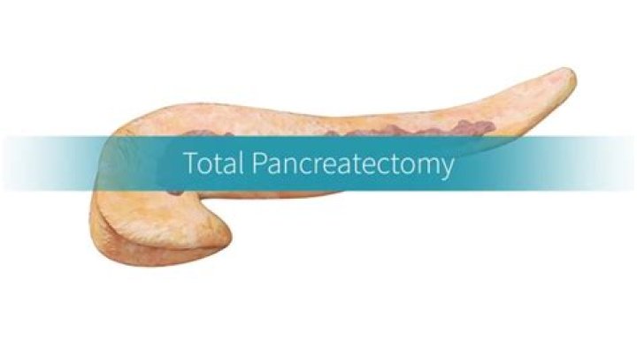 How dangerous is pancreatectomy?