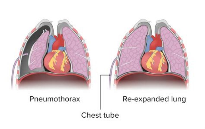 How do blebs cause pneumothorax?