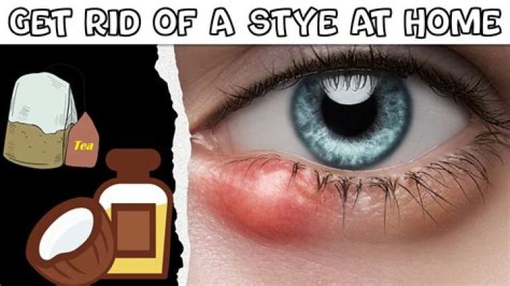How do you get rid of black eyes?