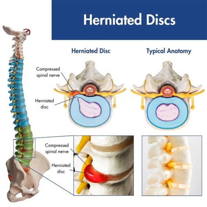 How herniated disc happens?