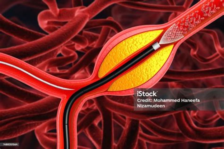 How is a arteriogram performed?