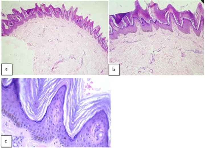 How is epidermodysplasia verruciformis transmitted?