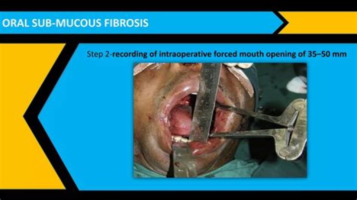 How is oral submucous fibrosis treated?