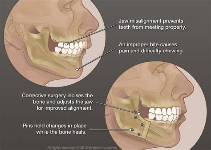 How much is jaw realignment surgery?